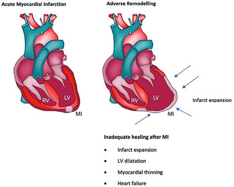 what causes lv dilation